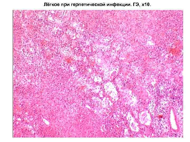 Лёгкое при герпетической инфекции. ГЭ, х10. 