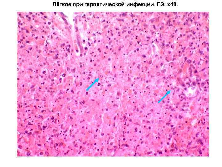Лёгкое при герпетической инфекции. ГЭ, х40. 