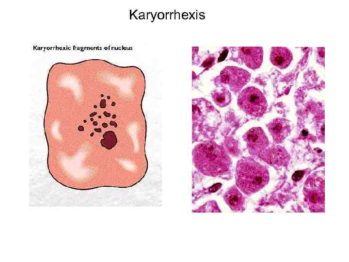Karyorrhexis 
