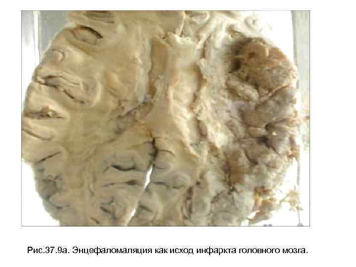 Рис. 37. 9 а. Энцефаломаляция как исход инфаркта головного мозга. 