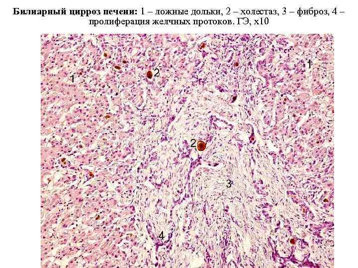 Билиарный цирроз печени: 1 – ложные дольки, 2 – холестаз, 3 – фиброз, 4