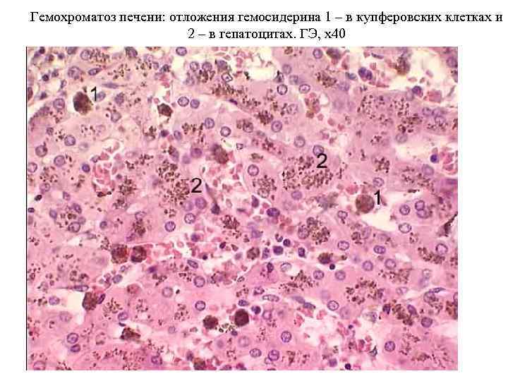 Гемохроматоз печени: отложения гемосидерина 1 – в купферовских клетках и    
