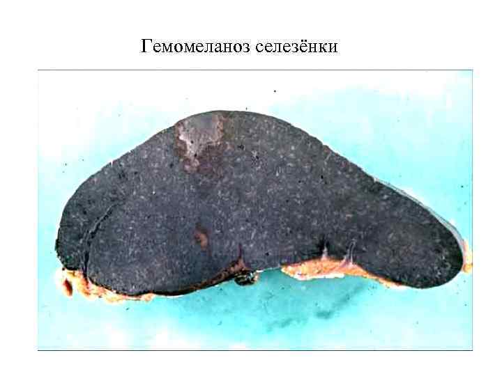 Гемомеланоз селезёнки 