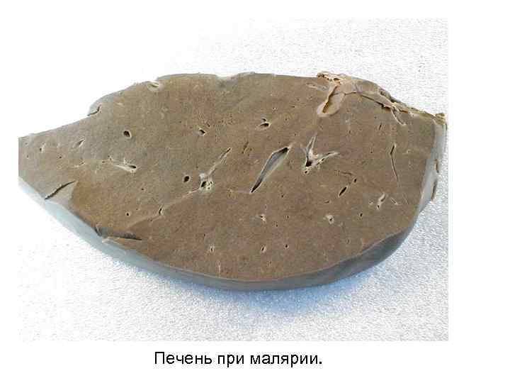 Печень при малярии. 