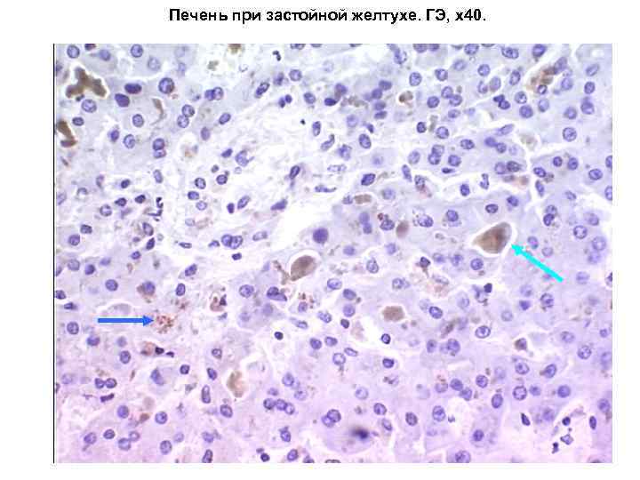 Печень при застойной желтухе. ГЭ, х40. 