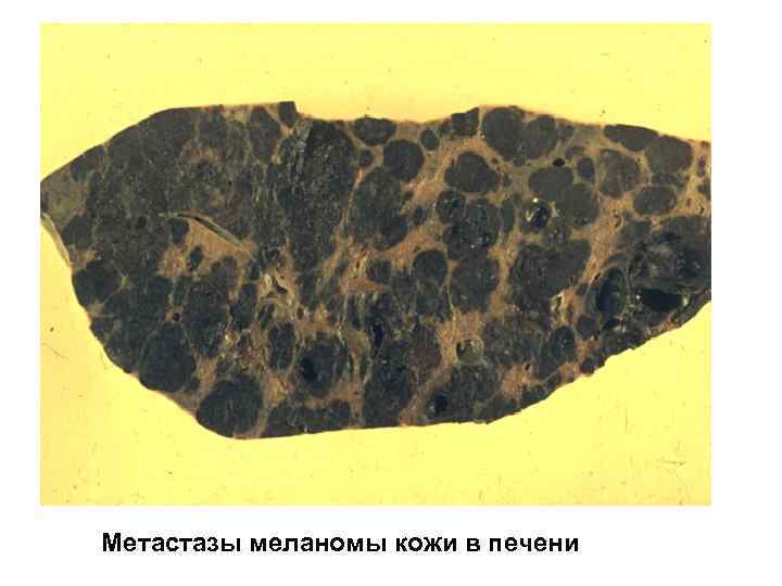 Метастазы меланомы кожи в печени 