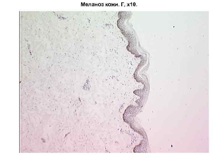 Меланоз кожи. Г, х10. 