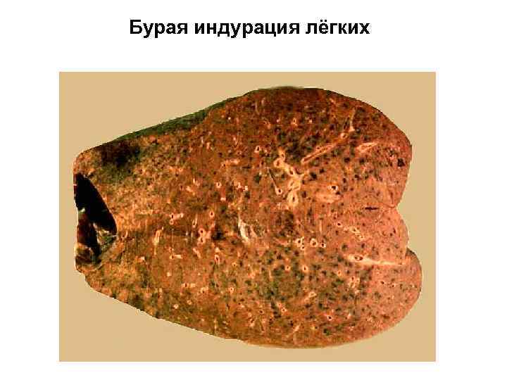 Бурая индурация лёгких 