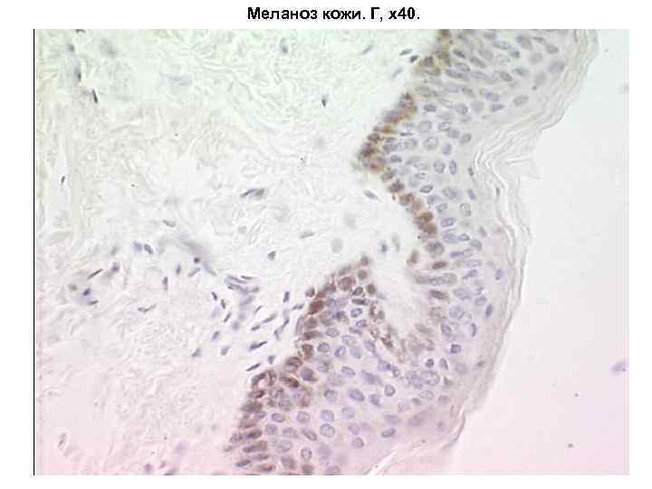 Меланоз кожи. Г, х40. 