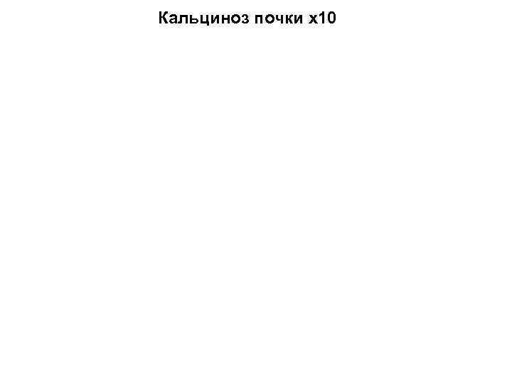 Кальциноз почки х10 