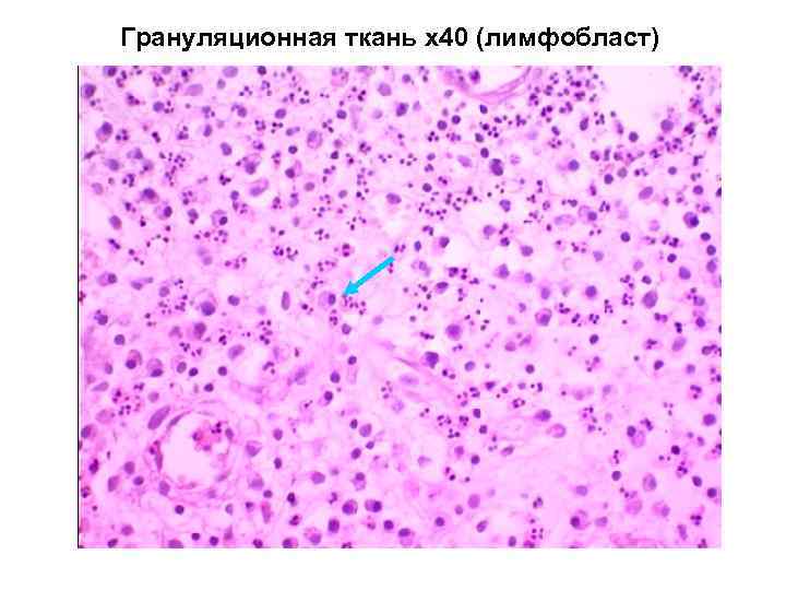 Грануляционная ткань. Грануляционная ткань микро. Грануляционная ткань микропрепарат. Грануляционная ткань патанатомия. Грануляционная ткань гистология.