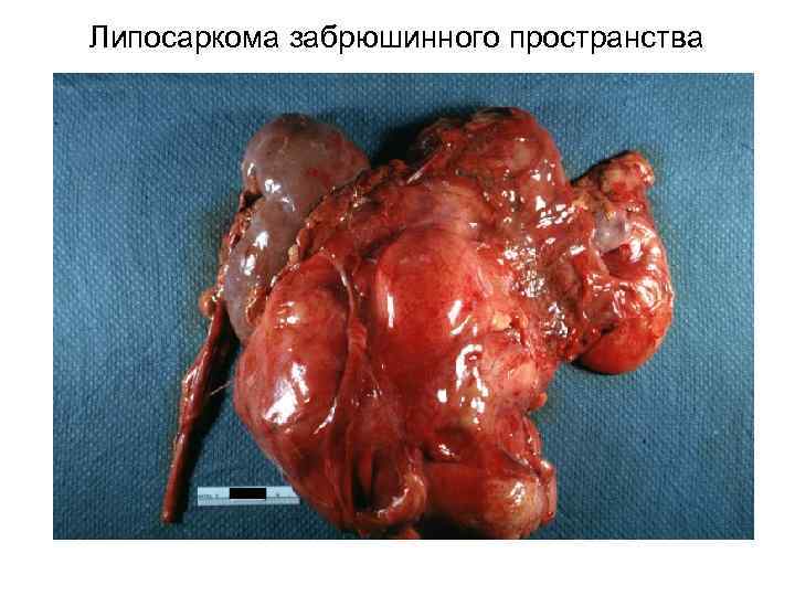 Липосаркома забрюшинного пространства 