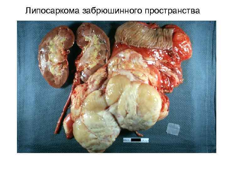 Липосаркома забрюшинного пространства 