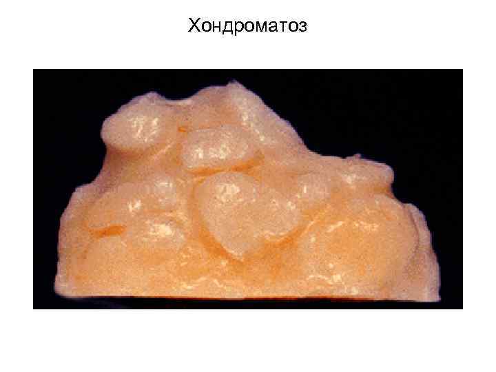 Хондроматоз 