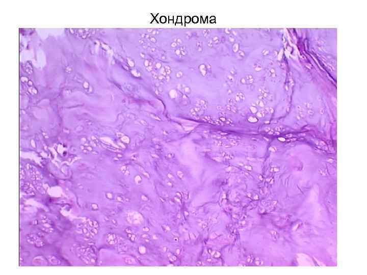 Хондрома 