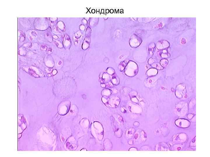 Хондрома 