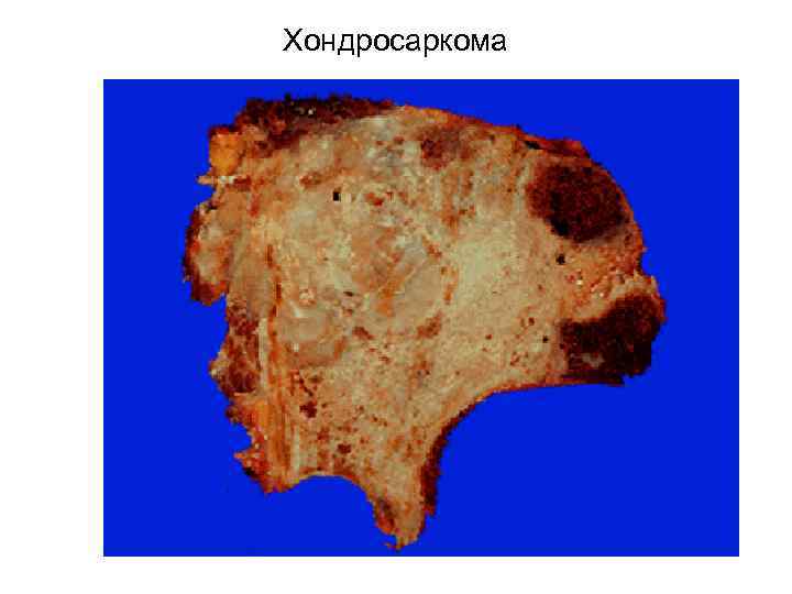 Хондросаркома 