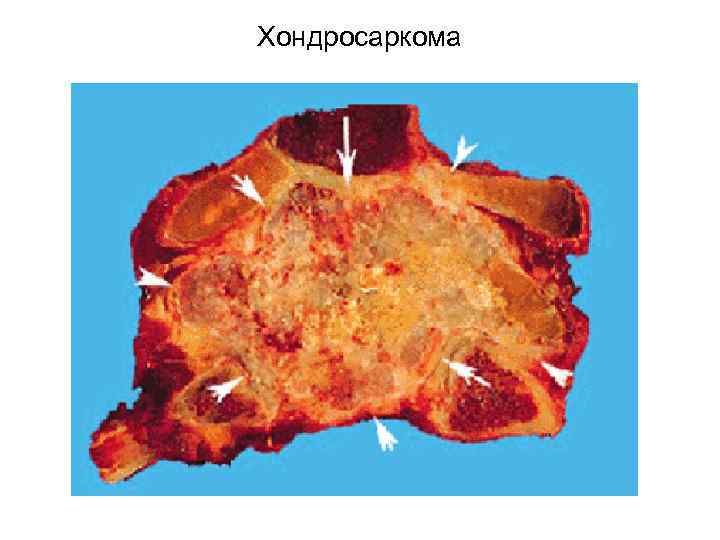 Хондросаркома 