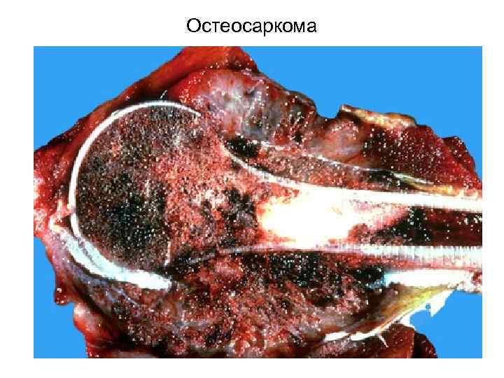 Остеосаркома 