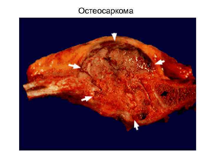 Остеосаркома 
