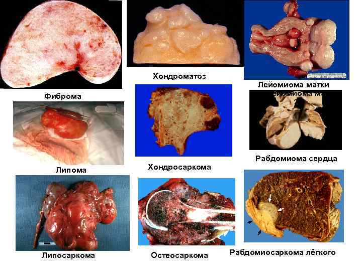     Хондроматоз       Лейомиома матки Фиброма