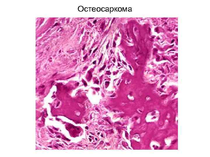 Остеосаркома 