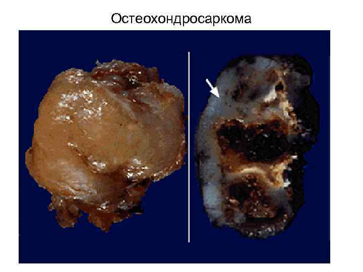 Остеохондросаркома 