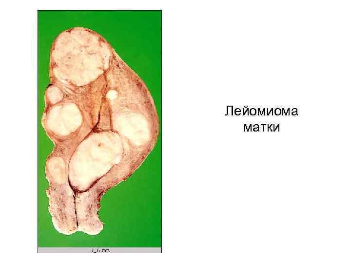 Лейомиома  матки 