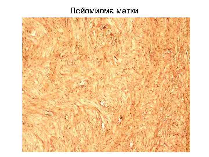 Лейомиома матки 