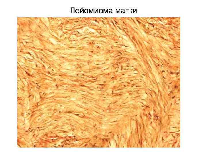 Лейомиома матки 