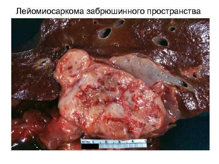 Лейомиосаркома забрюшинного пространства 