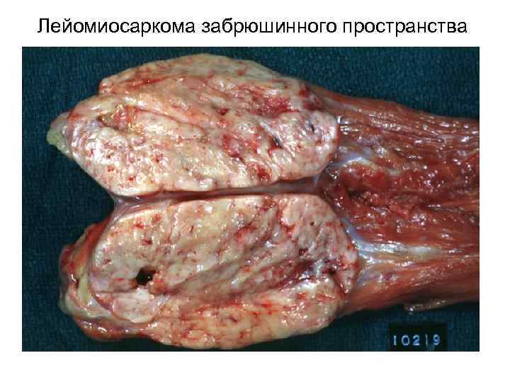 Лейомиосаркома забрюшинного пространства 