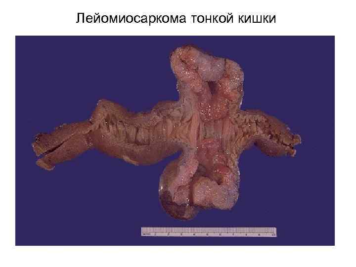 Лейомиосаркома тонкой кишки 