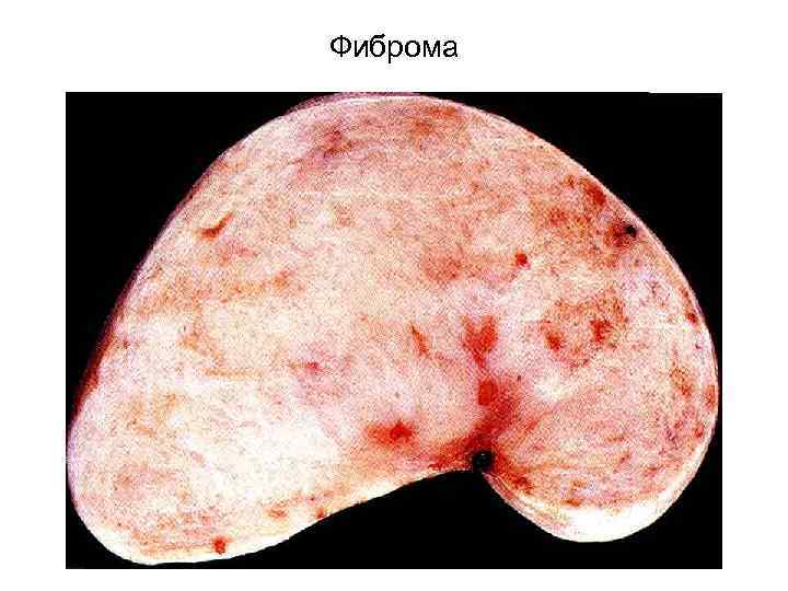 Фиброма 