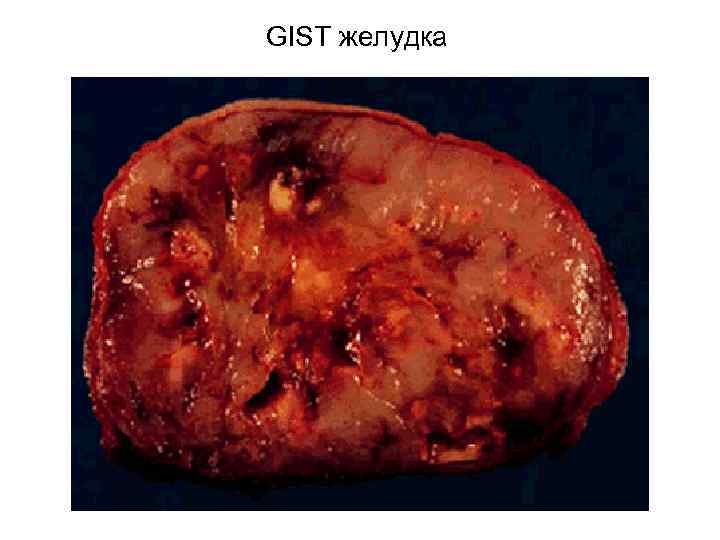 GIST желудка 