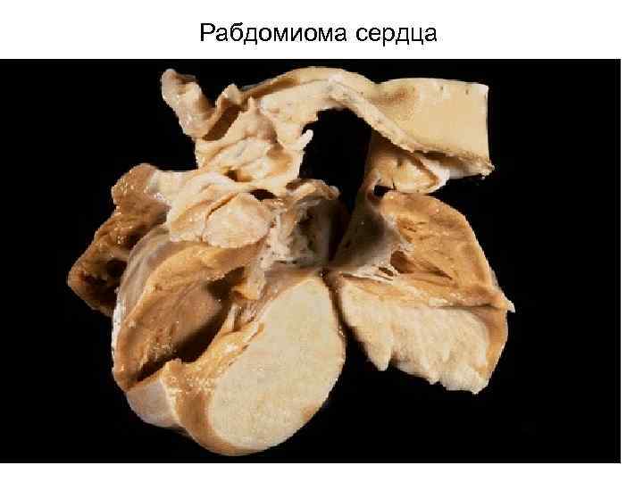 Рабдомиома сердца 