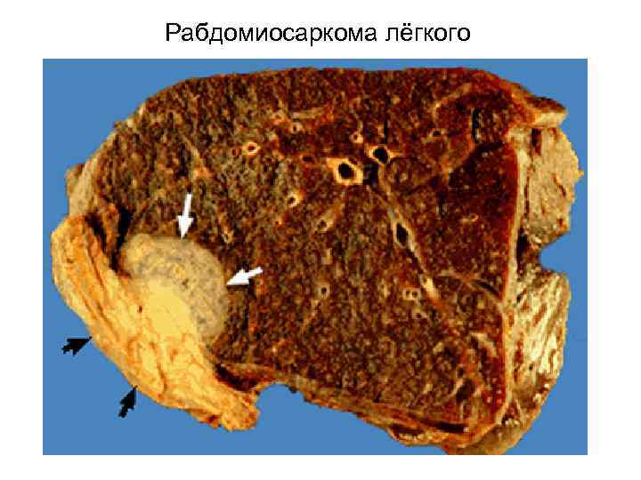 Рабдомиосаркома лёгкого 