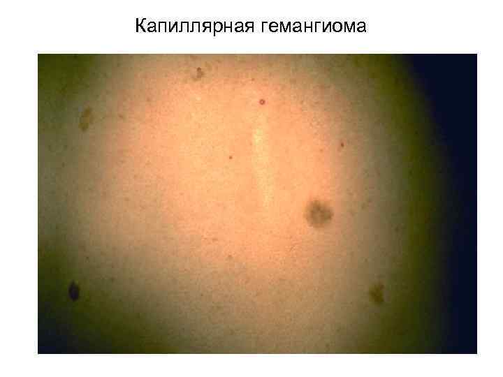Капиллярная гемангиома 