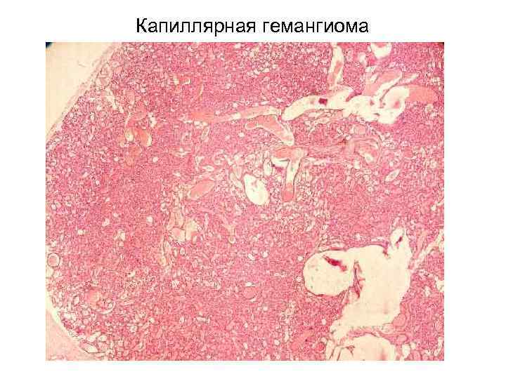 Капиллярная гемангиома 