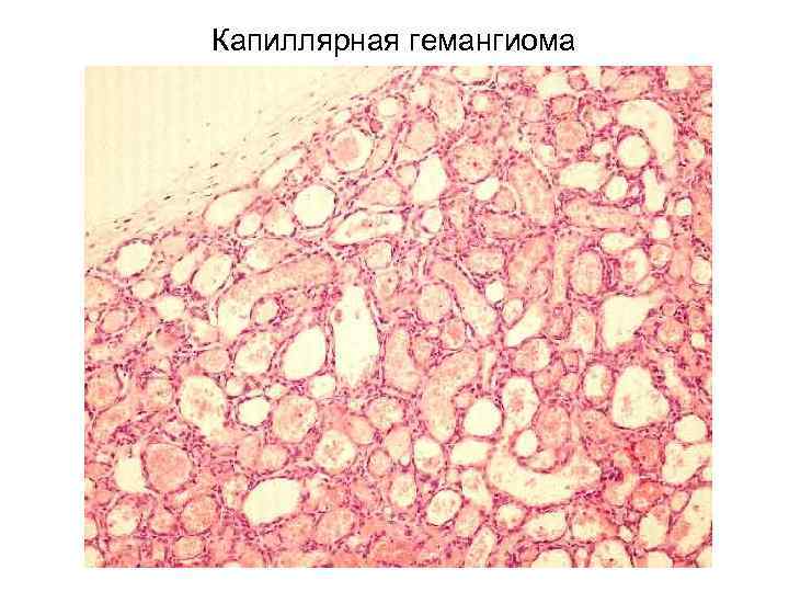 Капиллярная гемангиома 