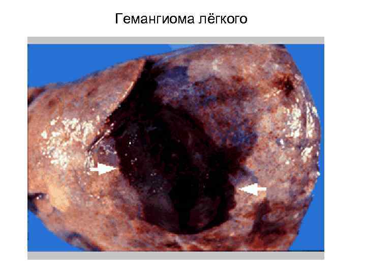 Гемангиома лёгкого 