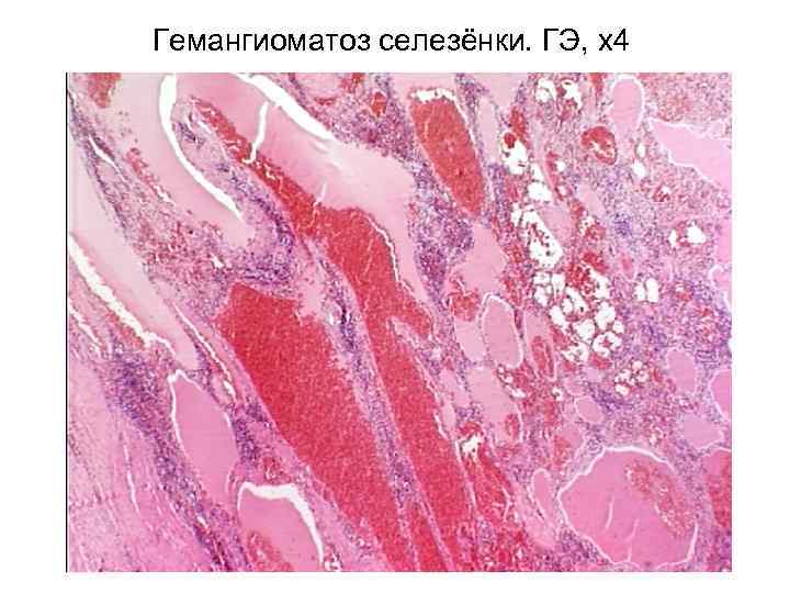 Гемангиоматоз селезёнки. ГЭ, х4 