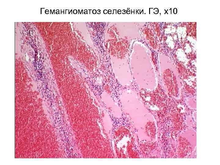 Гемангиоматоз селезёнки. ГЭ, х10 
