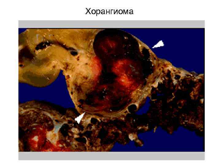 Хорангиома 