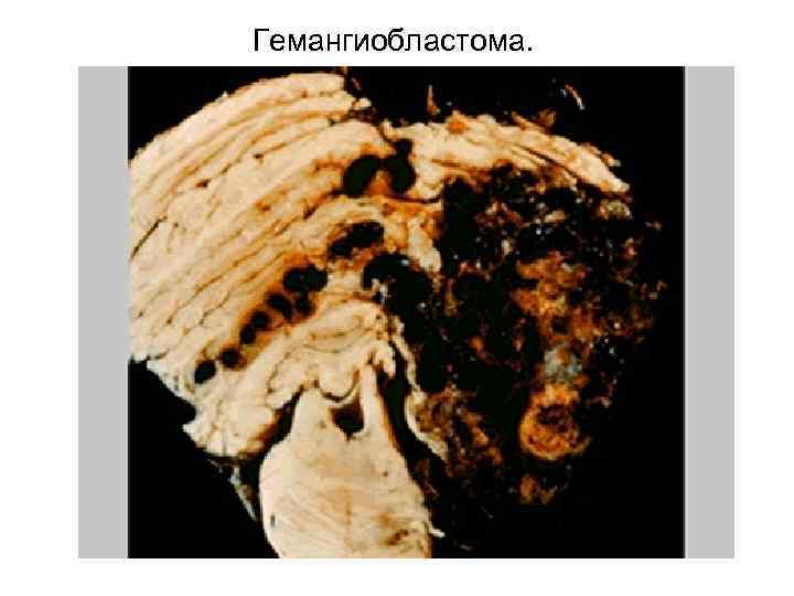 Гемангиобластома. 