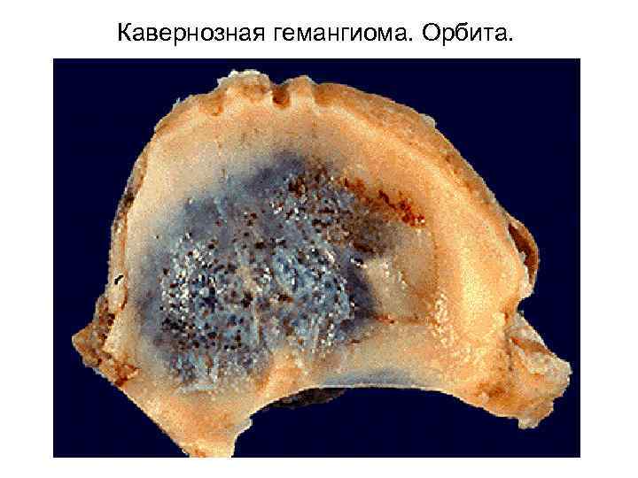 Кавернозная гемангиома. Орбита. 