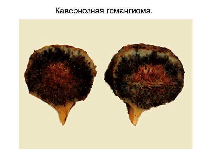 Кавернозная гемангиома. 