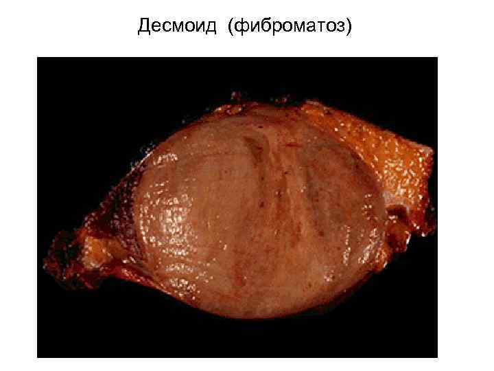 Десмоид (фиброматоз) 