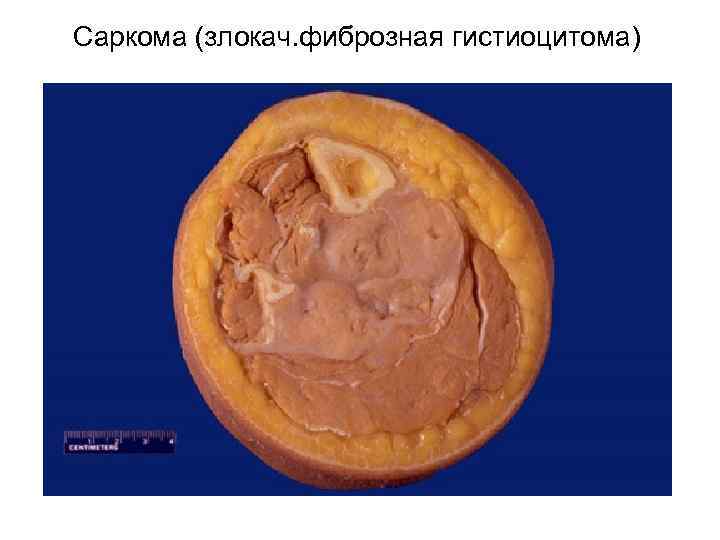 Саркома (злокач. фиброзная гистиоцитома) 
