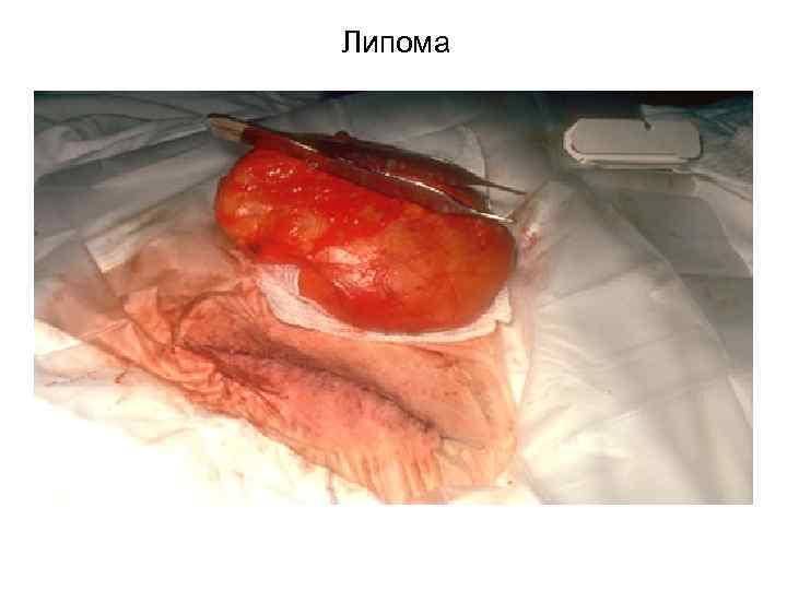 Липома 